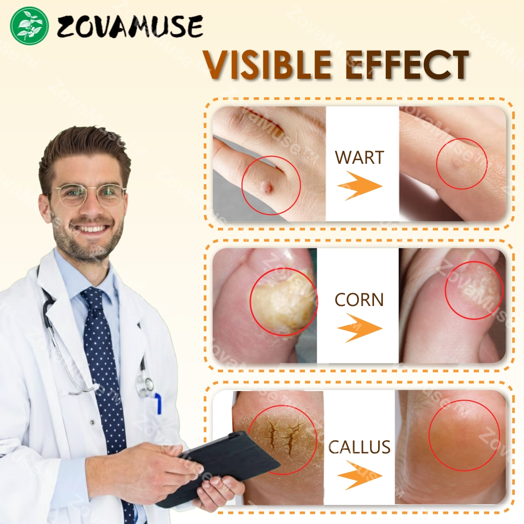 Bee Venom Corn & Callus Remover Cream - ZOVAMUSE