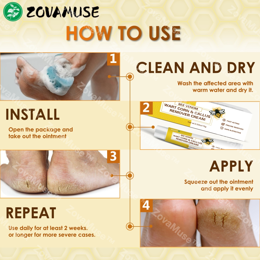 Bee Venom Corn & Callus Remover Cream - ZOVAMUSE