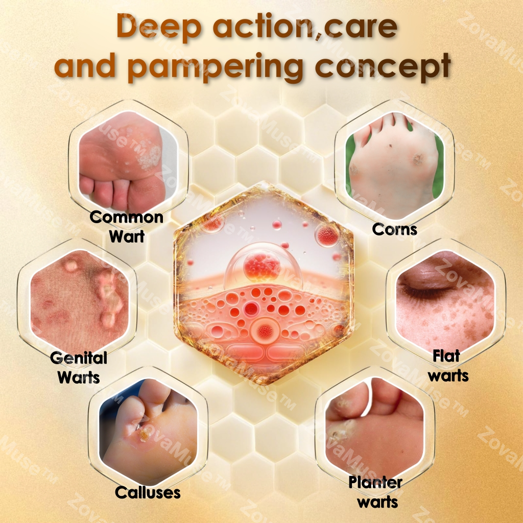Bee Venom Corn & Callus Remover Cream - ZOVAMUSE