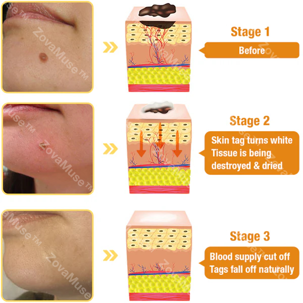Bee Venom Wart Remover Cream