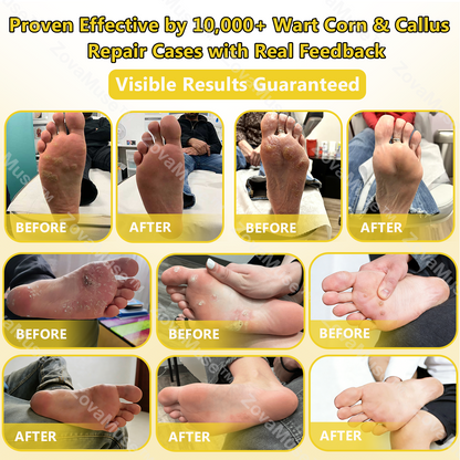 Bee Venom Corn & Callus Remover Cream - ZOVAMUSE