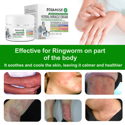 Ringworm Relief Cream for Itchy, Irritated Skin