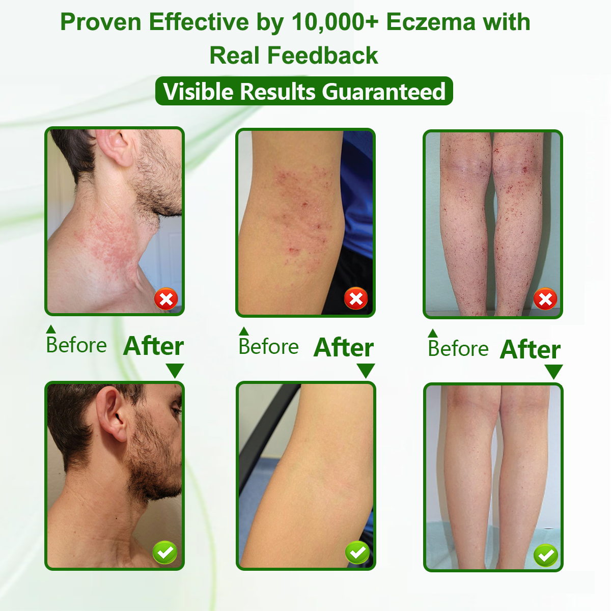 Herbal Miracle Cream for Stubborn Eczema