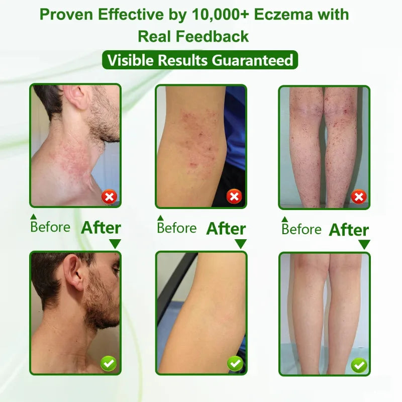 Eczema Relief Cream for Dry, Itchy Skin