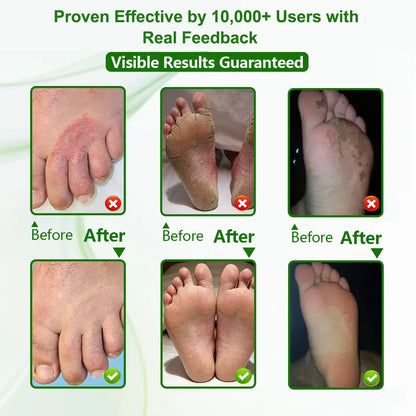 Athlete's Foot Relief Cream for Itchy, Burning Skin