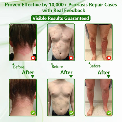 Psoriasis Relief Cream for Itchy, Flaky Skin